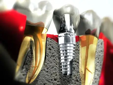 Best Dental Implants in Pune